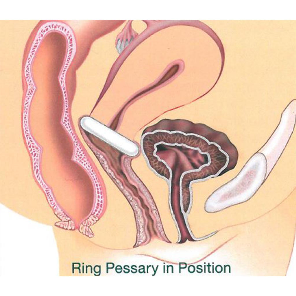 Gynéas Pessaires Gyn&Ring pessaire anneau T2 57 mm