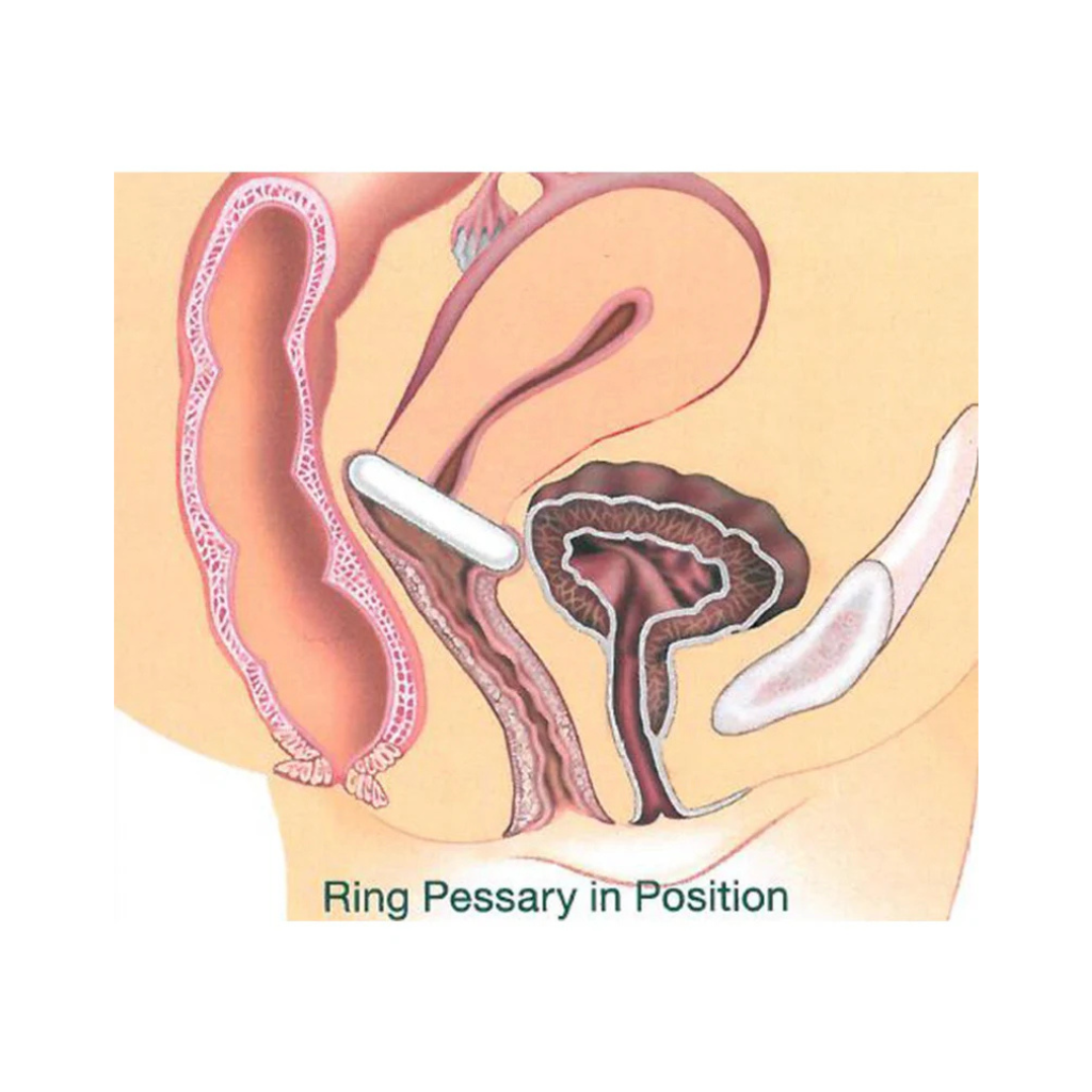 Gynéas Gyn&Ring kit pessaire anneau support T2 T4 T5