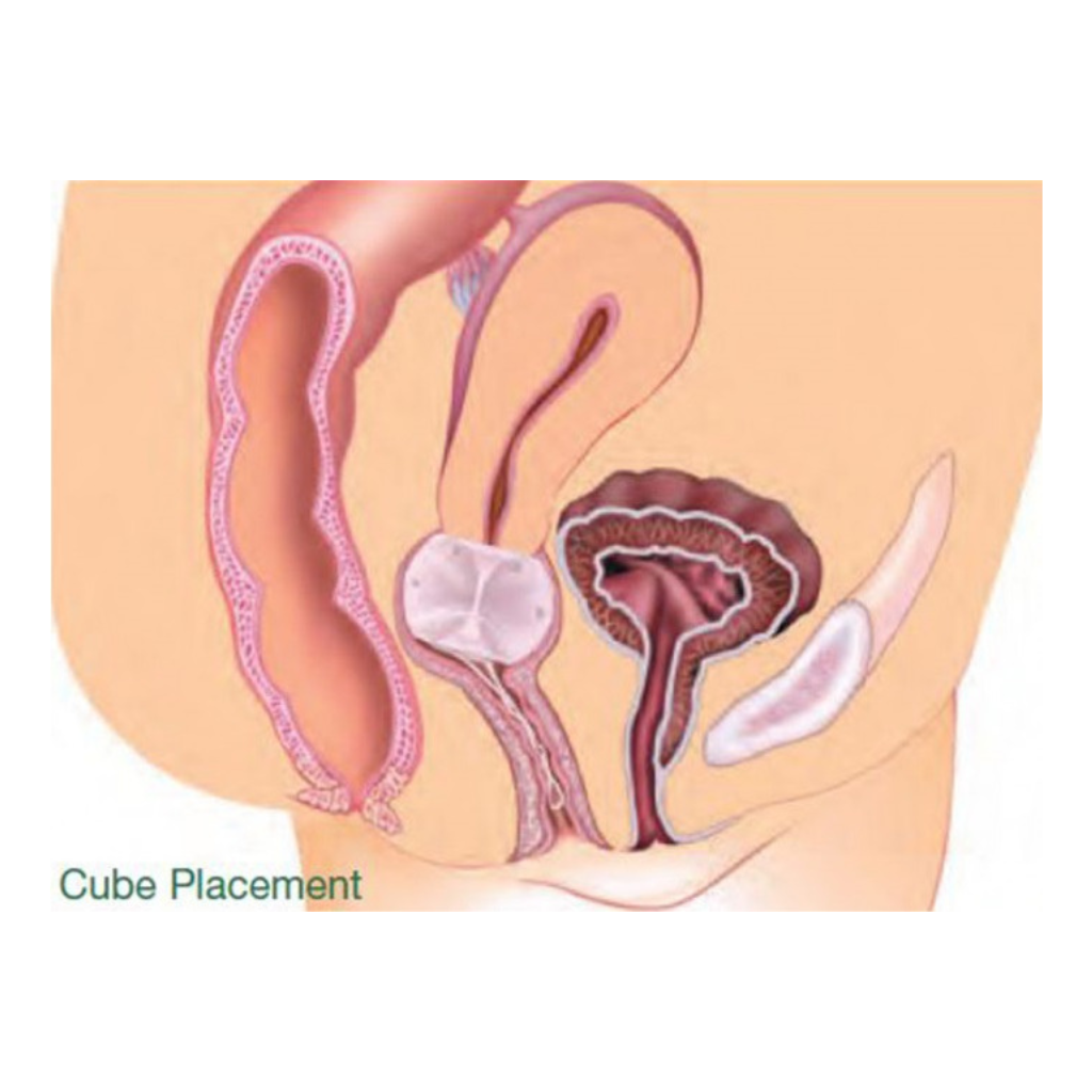 Gynéas Pessaires Kit Gyn&Cube silicone 3 tailles prolapsus