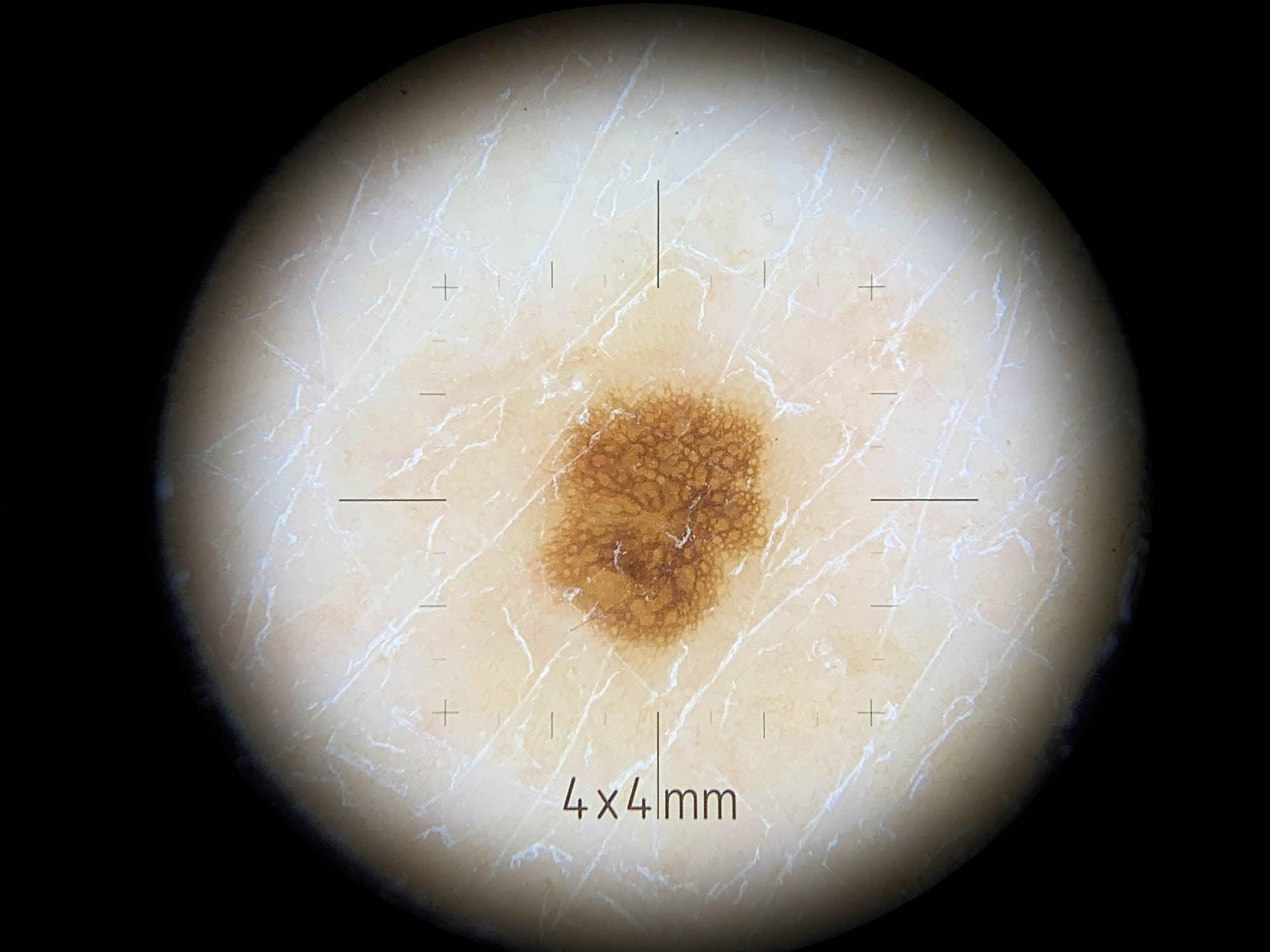 DermLite DL4 plaque contact petite zone 10 mm réticule